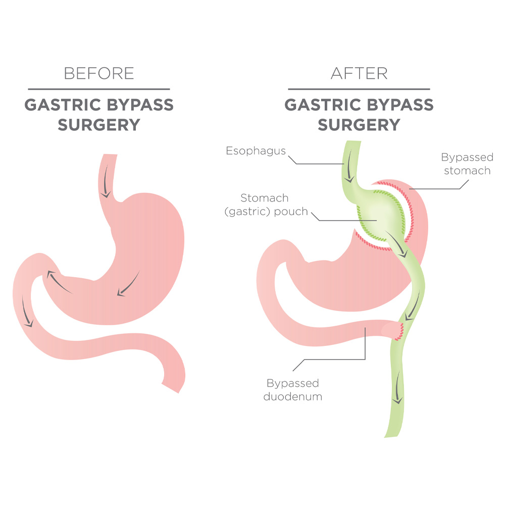 Obesity Surgery