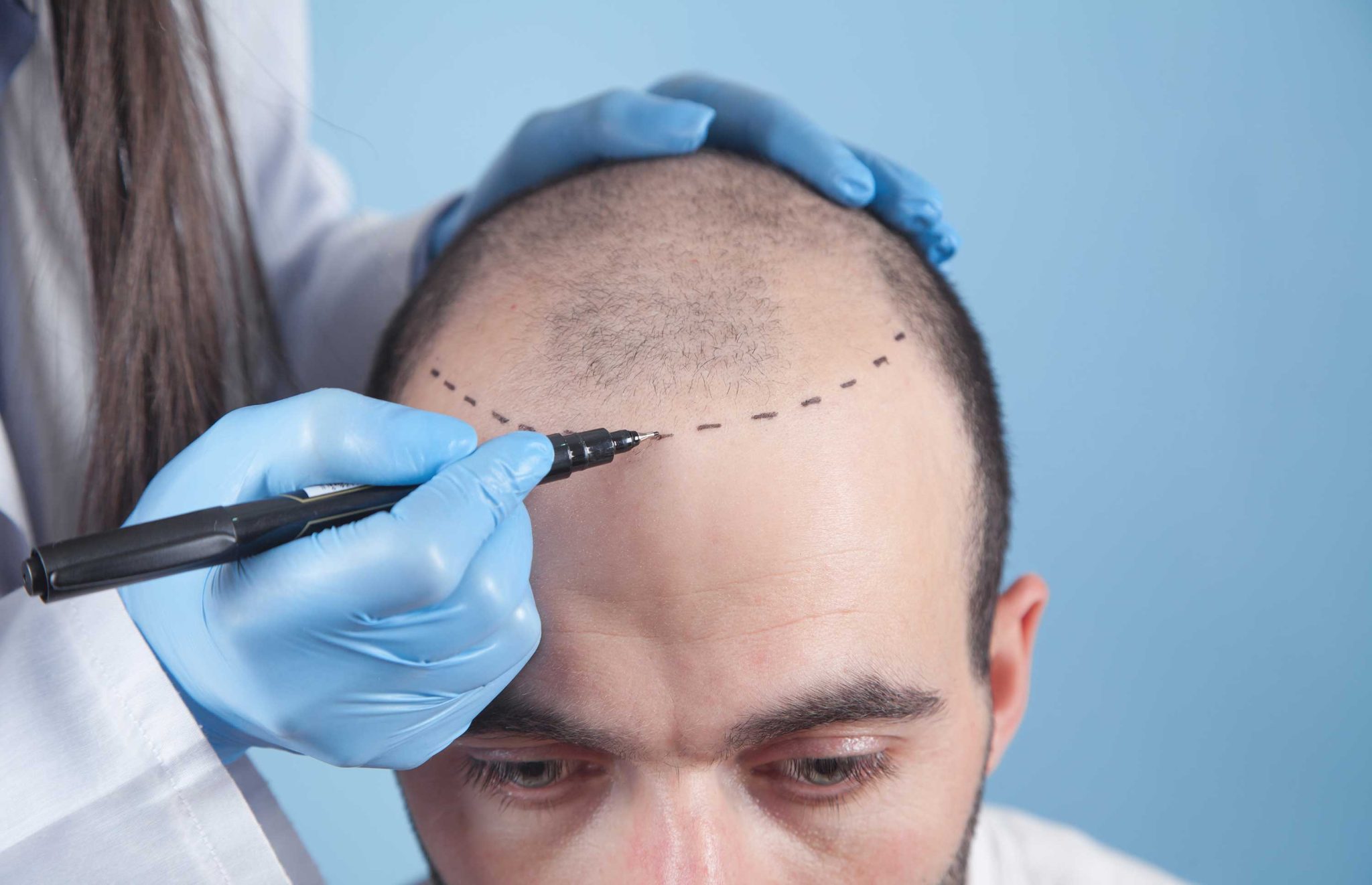 Hair Transplantation