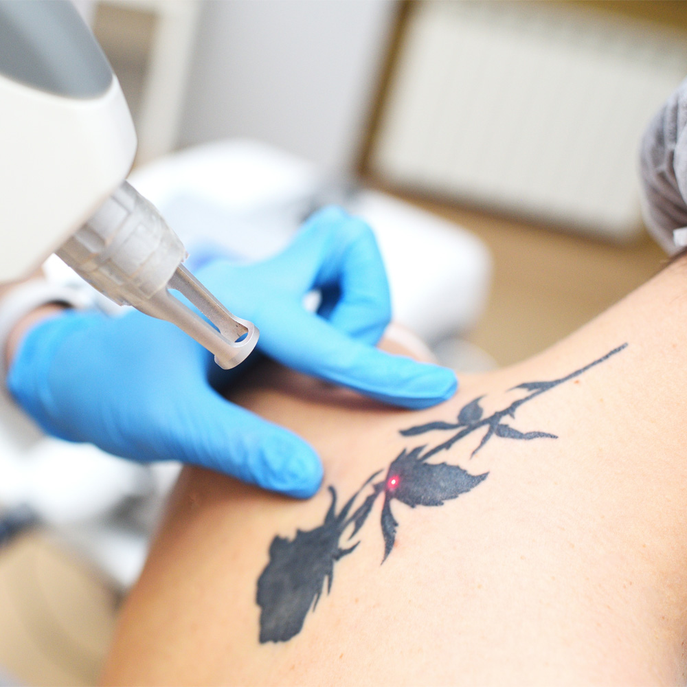 Laser Tattoo Removal