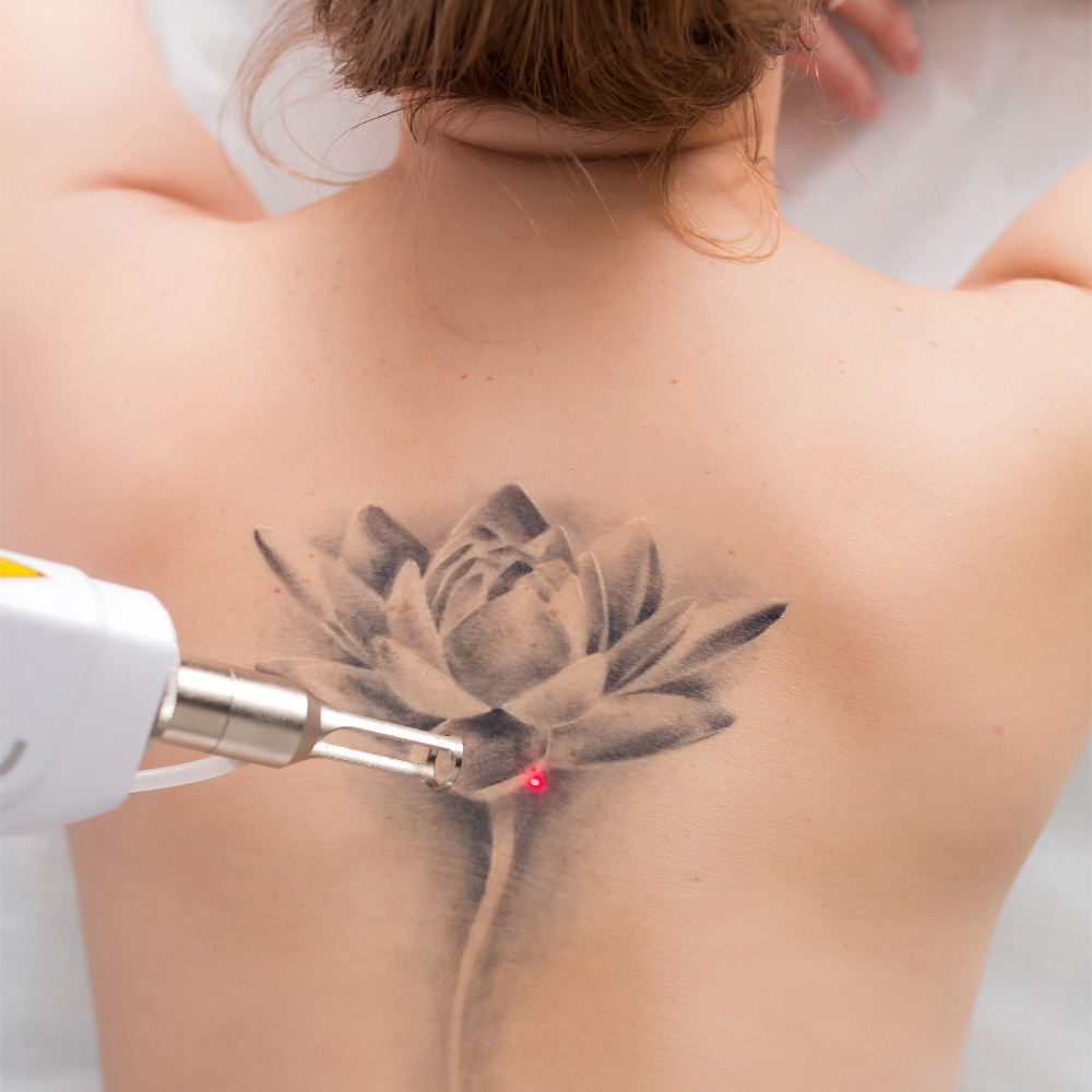 Laser Tattoo Removal