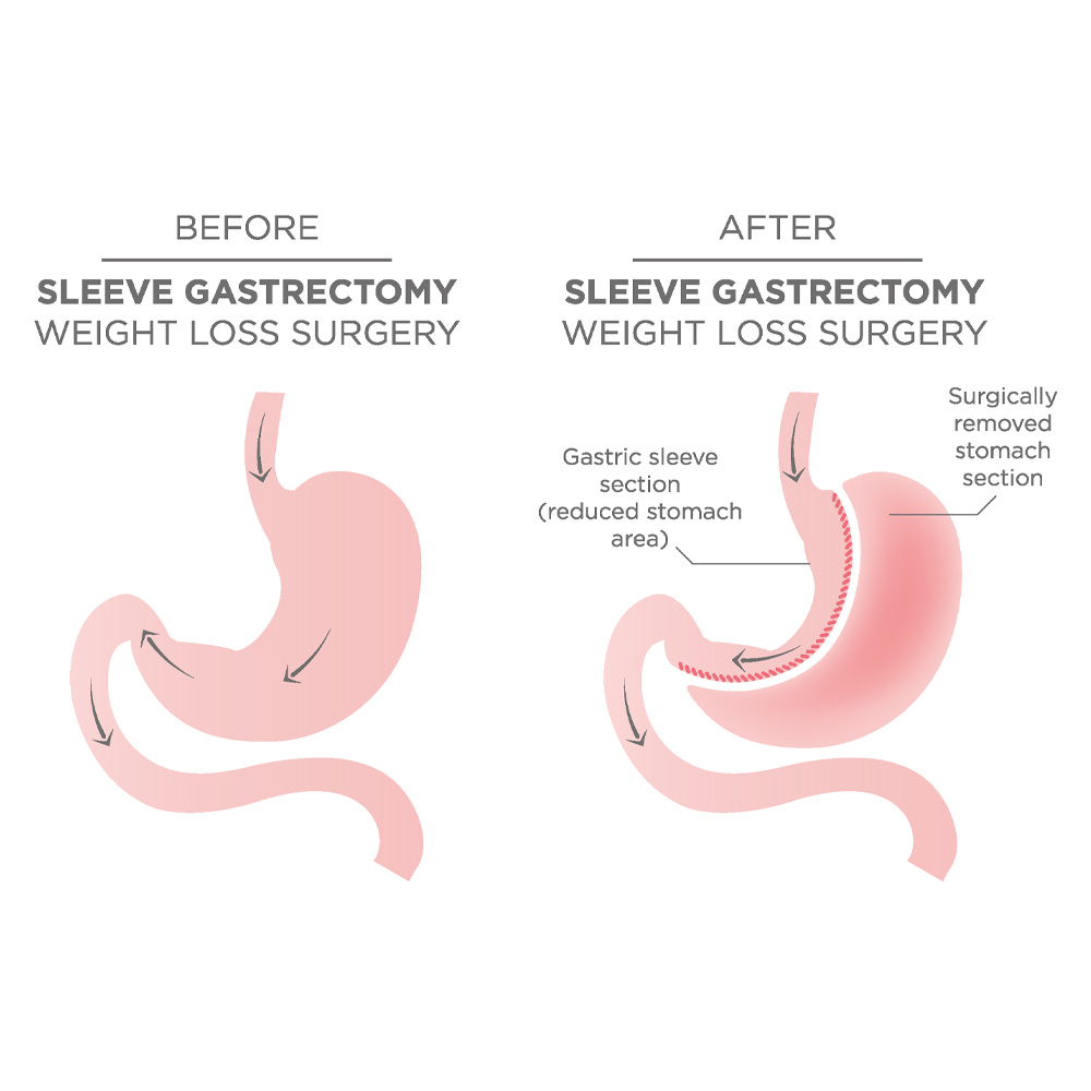 Obesity Surgery